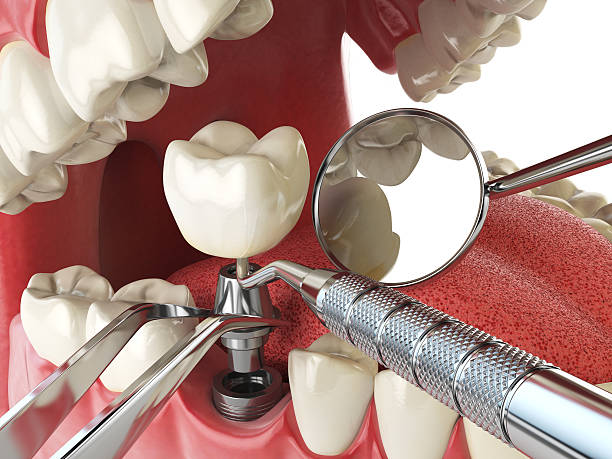 Best Emergency Dental Care for Broken or Chipped Teeth in , FL